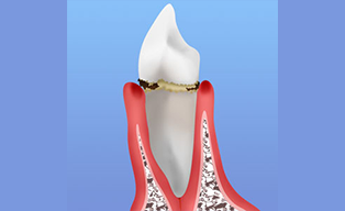 初期の歯周病