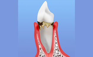 中期の歯周病