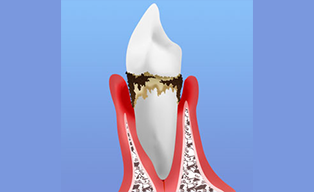 重度の歯周病
