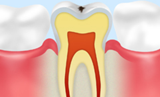 ごく初期のむし歯【C0】