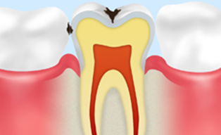 エナメル質のむし歯【C1】