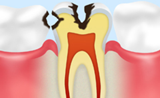 象牙質のむし歯【C2】