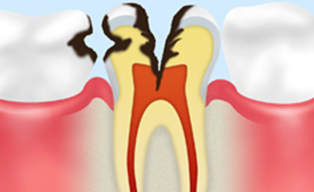 神経のむし歯【C3】