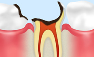 歯根のむし歯【C4】